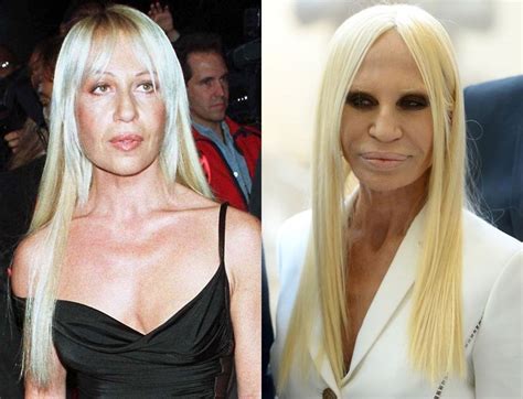 donatella versace luigi|donatella versace before and after surgery.